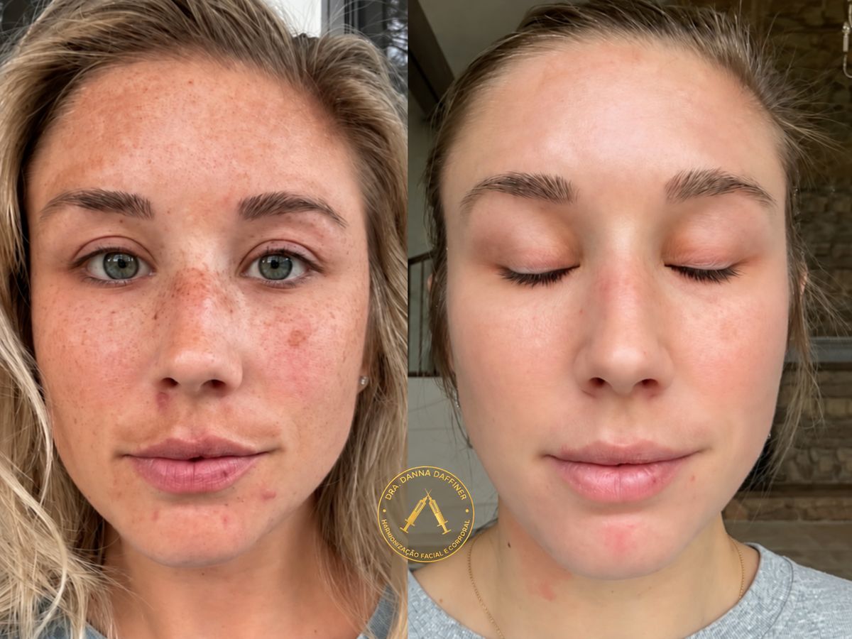 Antes e depois de tratamento de melasma