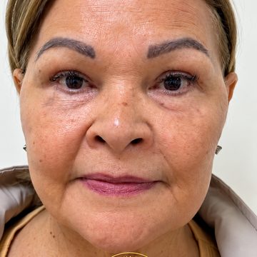 Bioestimulador de colágeno facial