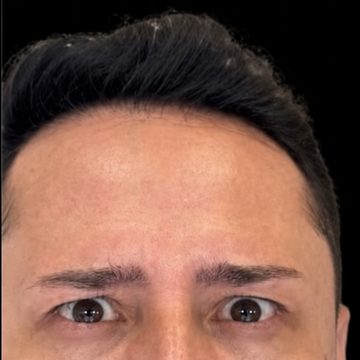 Botox facial