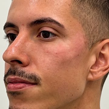 Harmonização facial masculina