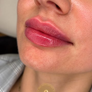 Preenchimento labial