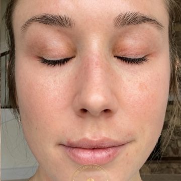 Melasma