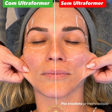 Ultraformer